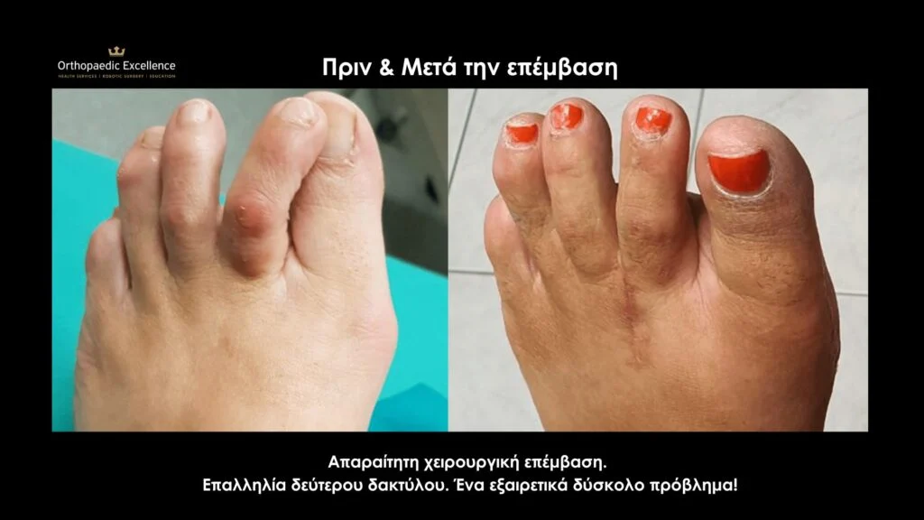 Πόδια πριν και μετά τη χειρουργική διόρθωση για κότσι (βλαισό μεγάλο δάκτυλο)