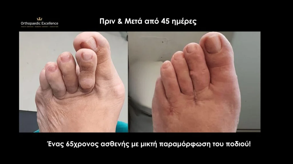 Αποτέλεσμα πριν και μετά την επέμβαση για κότσι στο πόδι